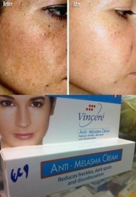 melasma treatment cream