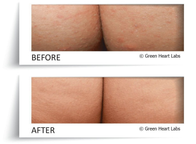 lotion for butt acne